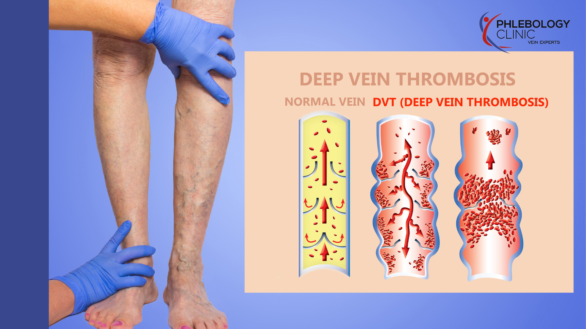 Μεταθρομβωτικό-σύνδρομο-Συμβουλές-πρόληψης
